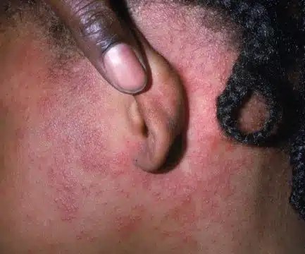 The measles rash often appears behind the ears when it starts on the face.