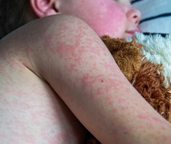 Child with a measles rash on body and arms